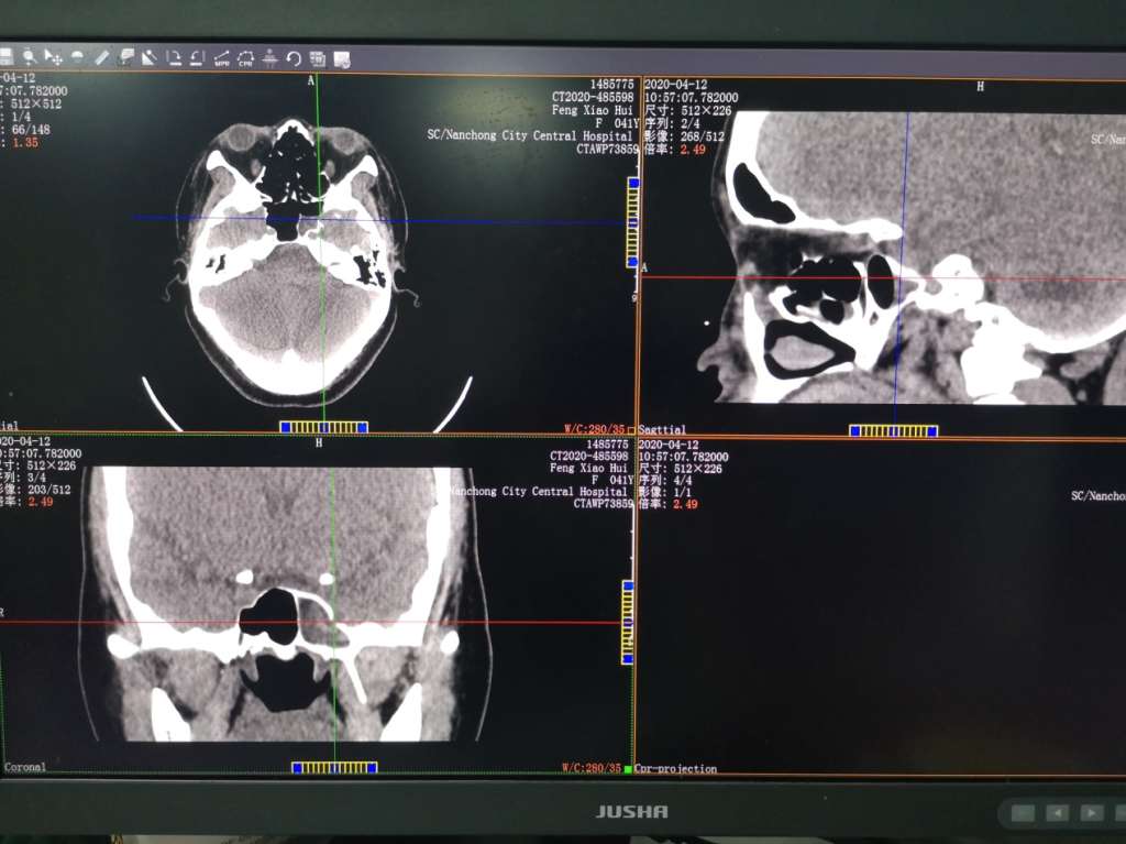 患者2:水平位,矢状位,冠状位ct显示的病变部位