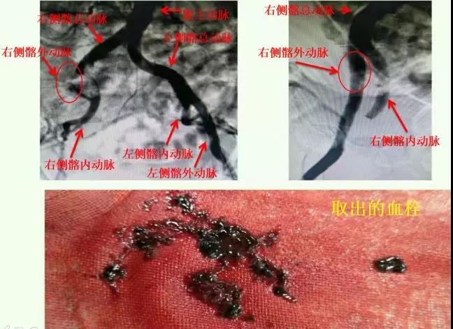 全国罕见蒲阿姨同时遭遇左侧大脑中动脉闭塞右侧髂外动脉闭塞这家医院