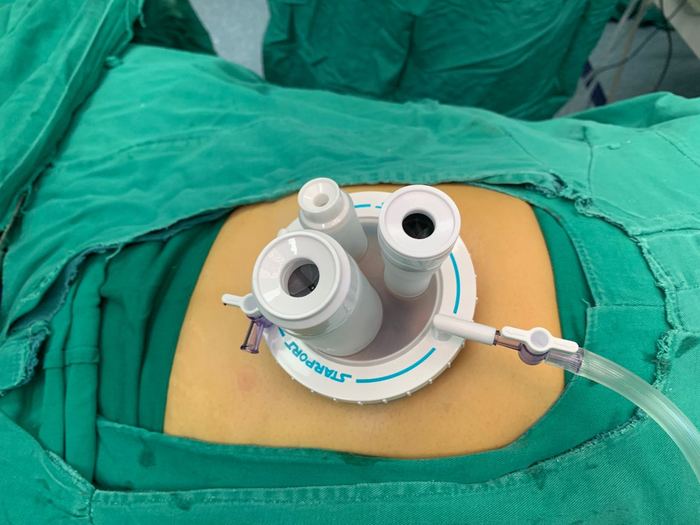腹腔镜手术图片 打孔图片