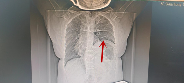 术前术后罗晖介绍,膈膨升是一种由于膈肌自身发育不全,麻痹或萎缩