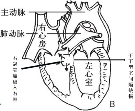 主动脉窦解剖图三维图片