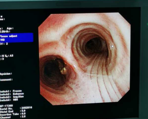 支气管内软骨错构瘤困扰患者10余年钬激光镜下消融术成功切除
