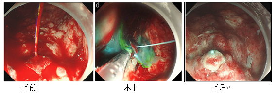 时间就是生命!危急关头,张涛决定为李婆婆施行组织胶封堵术.
