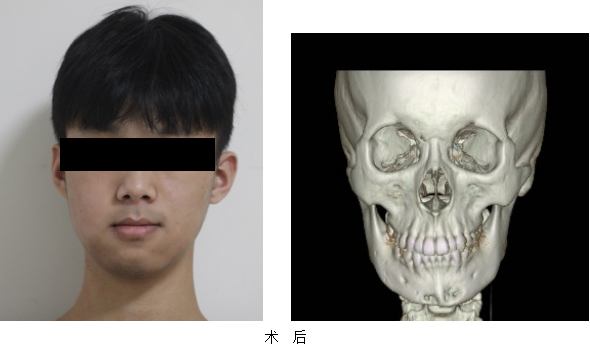 全市首例市中心醫院應用數字化外科設計完成一例骨性面部輪廓整形術